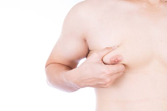 Male gynecomastia surgery in Mexico City — Argaman Surgeries