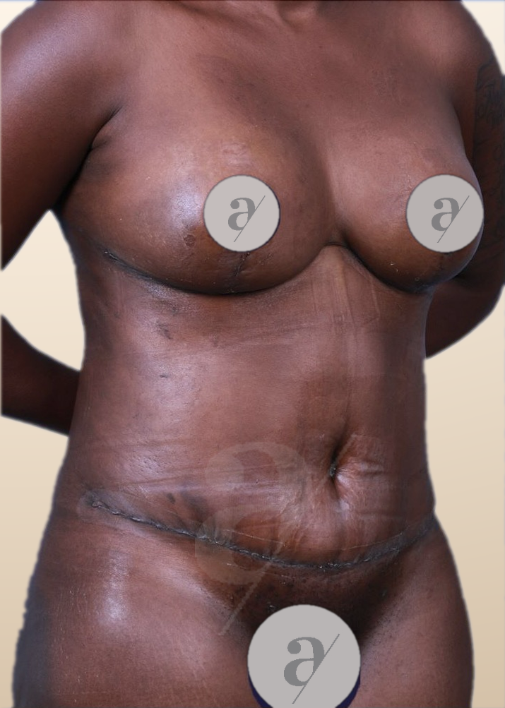After &mdash; Mommy Makeover in Mexico City, Argaman Plastic Surgeries Mexico