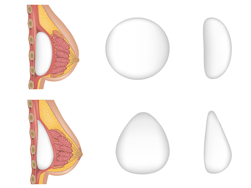 Teardrop vs round silicone breast implants — shape, profile and projection comparison, Argaman Plastic Surgeries Mexico City